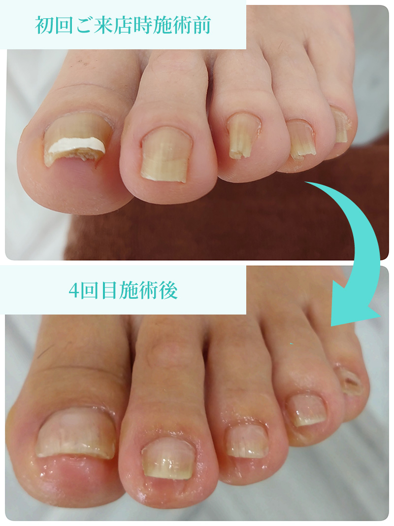 初回ご来店時施術前