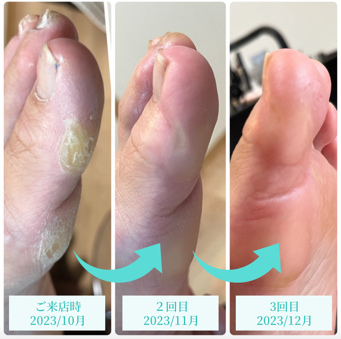 初回ご来店時施術前