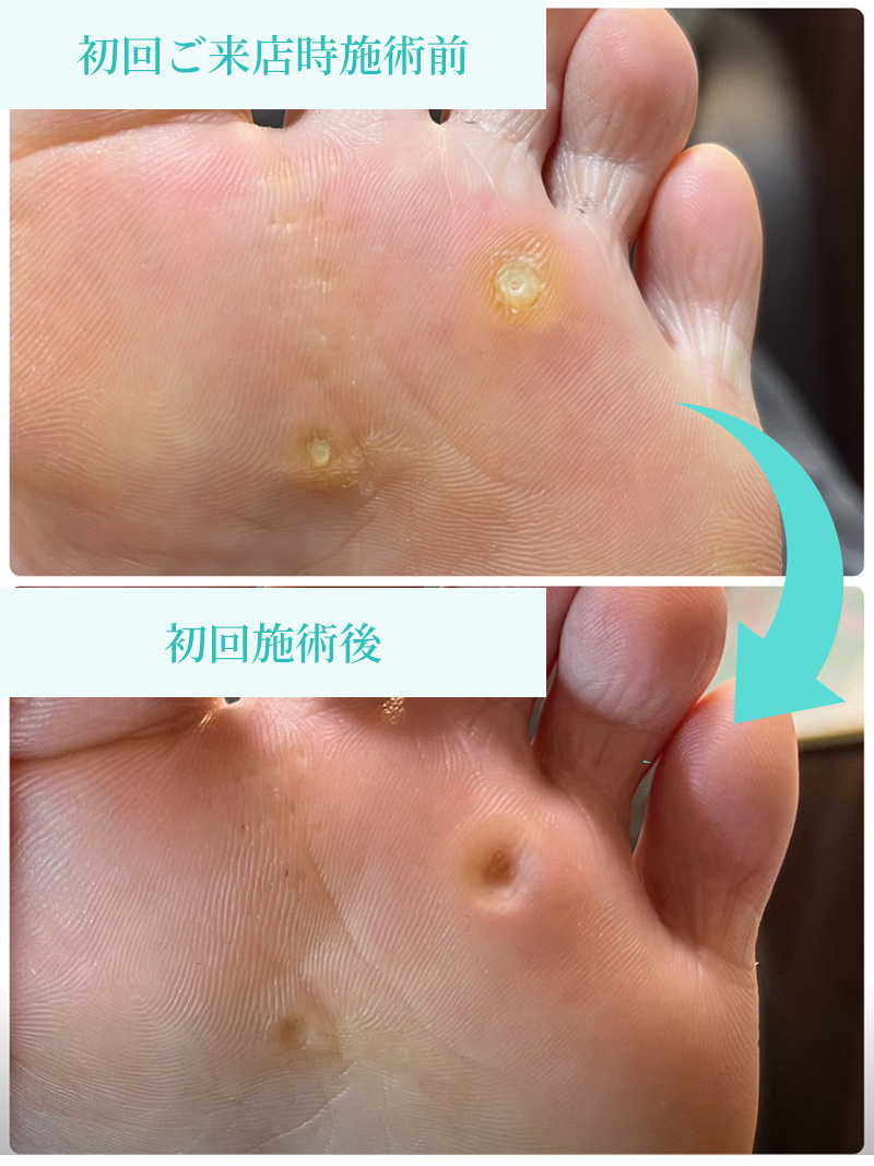 初回ご来店時施術前